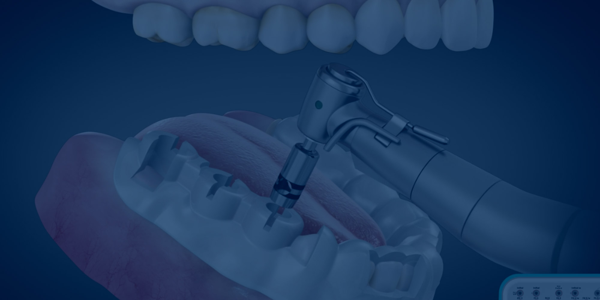 Sinus Lift (Simple)