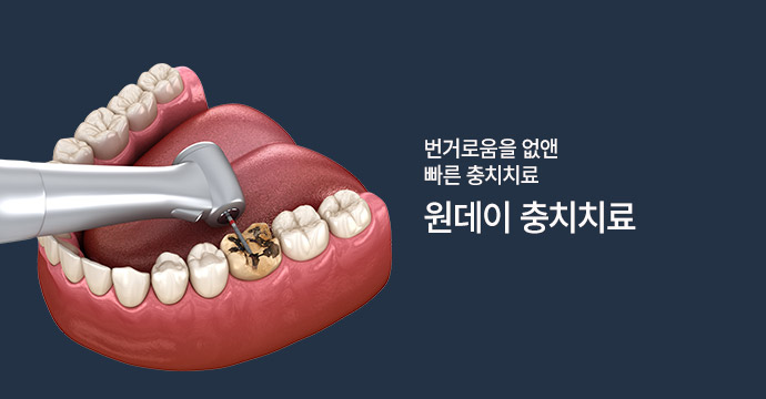 Implant – Front Tooth (Domestic)