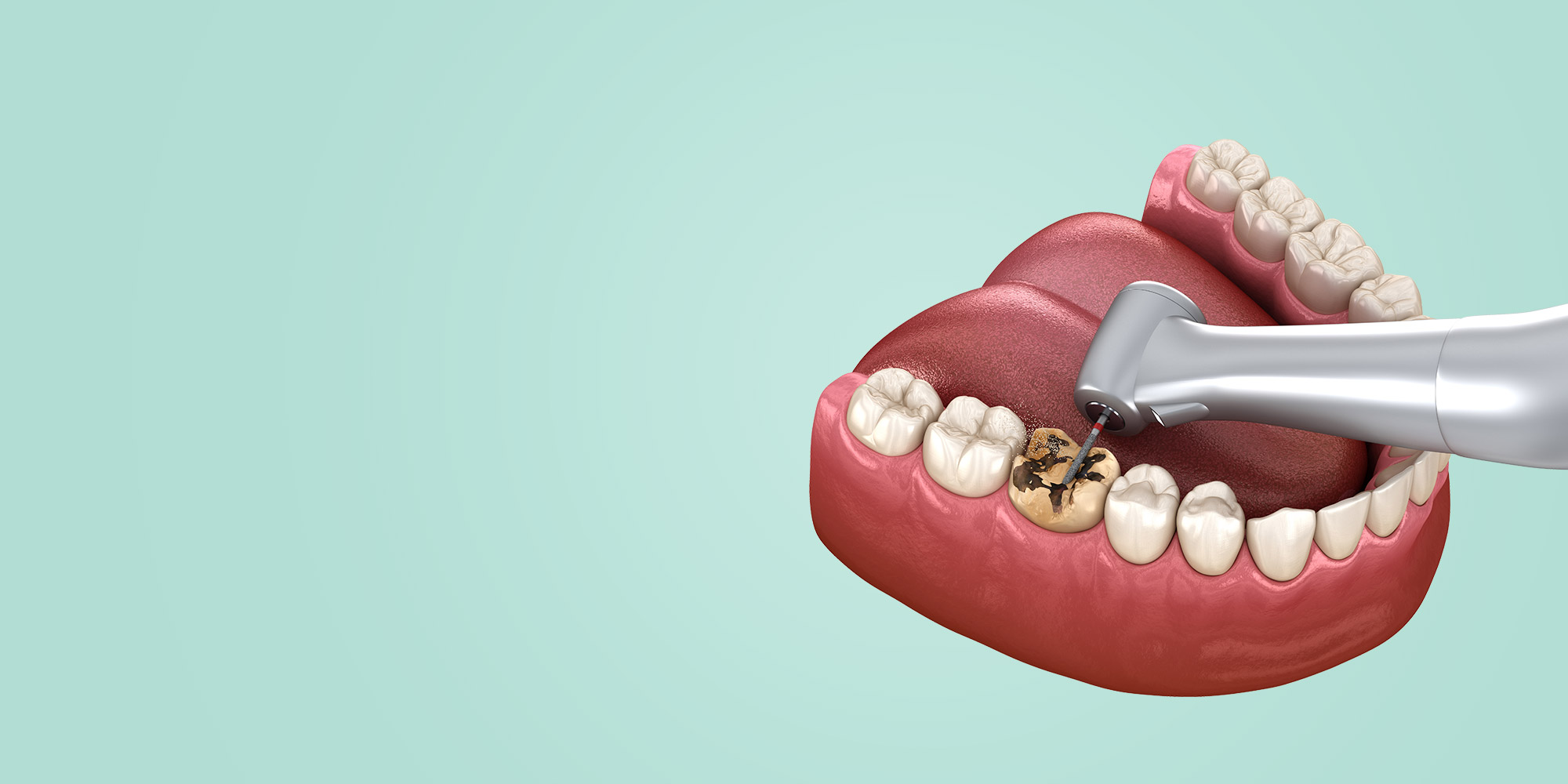 Spacing / Gap Teeth Correction